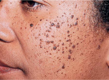 Best Skin Care Clinic in Vijaynagar