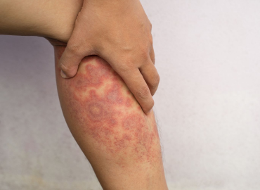 Best Skin Care Clinic in Vijaynagar