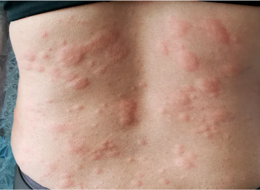 Best Skin Care Clinic in Vijaynagar