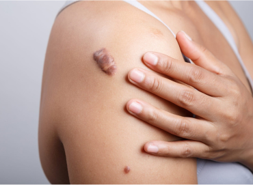 Best Skin Care Clinic in Vijaynagar
