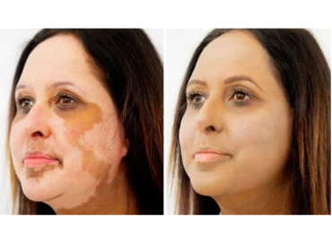 Best Skin Care Clinic in Vijaynagar